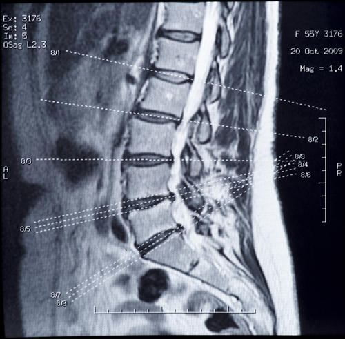 Stamceltherapie bij hernia - Dorsoo