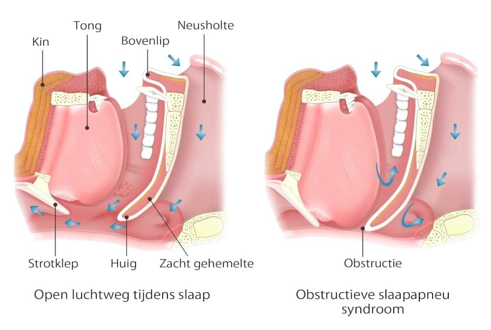 Tekening obstructief slaapapneu syndroom