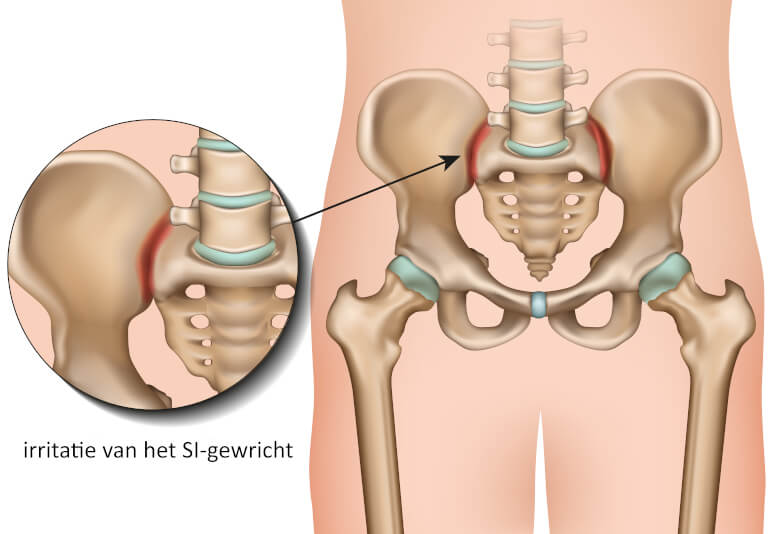 irritatie van het SI-gewricht