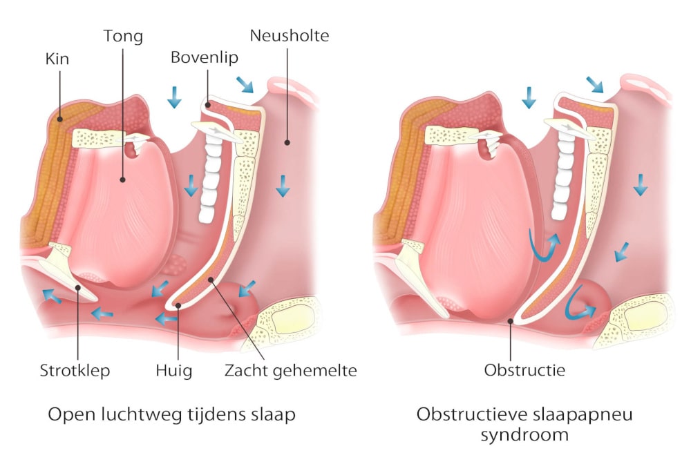 Dorsoo blog obstructieve slaapapneu luchtweg