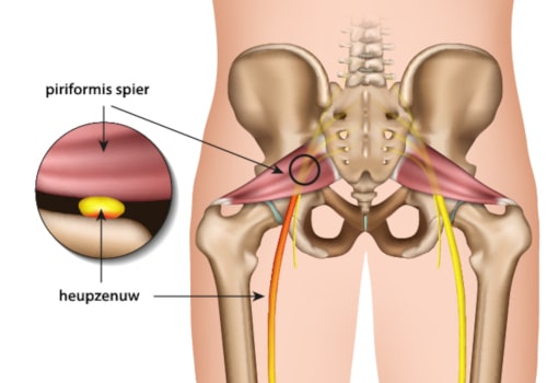 piriformis syndroom - waar zit de piriformis spier?