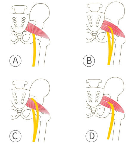 piriformis spier en ischias zenuw