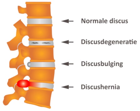 discusdegeneratie discusbulging discushernia