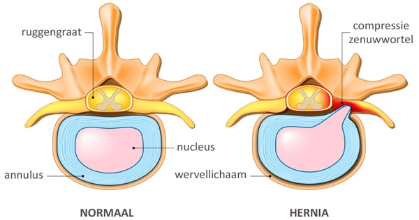 wat is een hernia